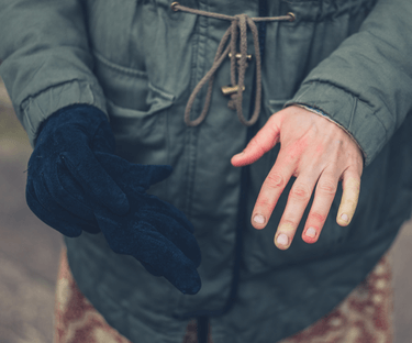 Photo of hand that is discolored; one had has a glove on it.
