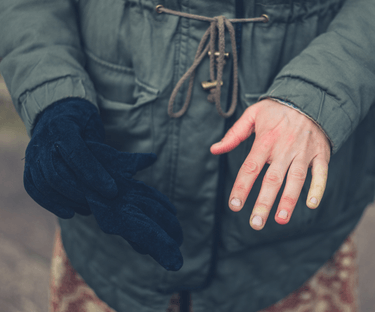 Photo of hand that is discolored; one had has a glove on it.